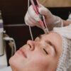 Microneedling Myths & Facts