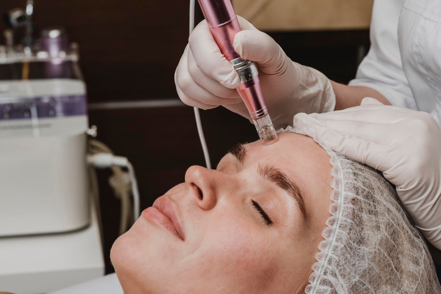 Microneedling Myths & Facts
